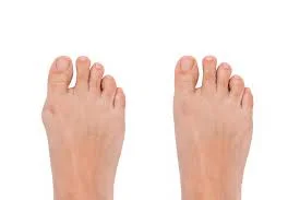 Halluks Valgus Tedavisi