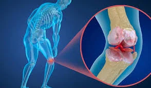 Osteoporoz Tedavisi